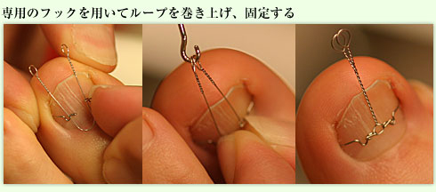 VHO式矯正技術 専用のフックを用いてループを巻き上げ、固定する